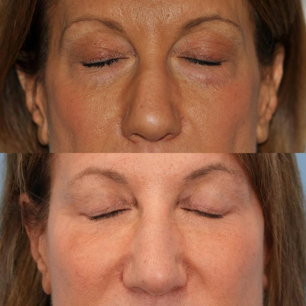 Blepharoplasty Before & After Gallery - Patient 234495 - Image 3