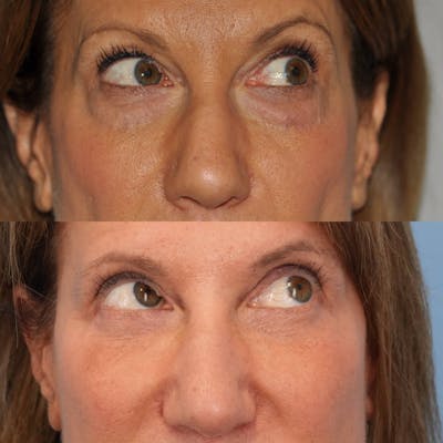 Blepharoplasty Before & After Gallery - Patient 234495 - Image 4