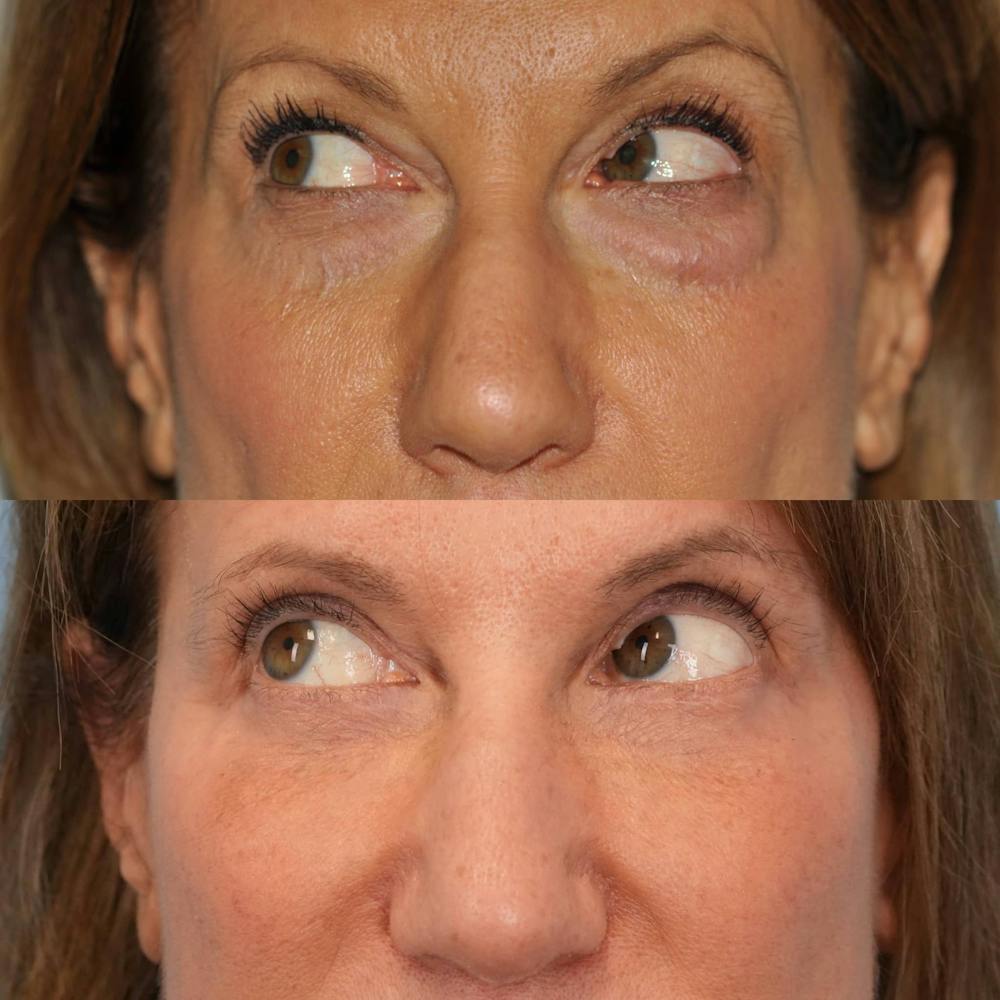 Blepharoplasty Before & After Gallery - Patient 234495 - Image 5