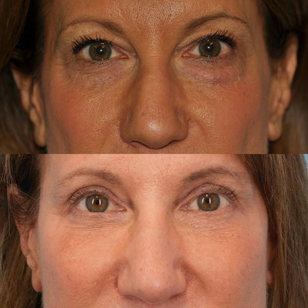 Blepharoplasty Before & After Gallery - Patient 234495 - Image 1