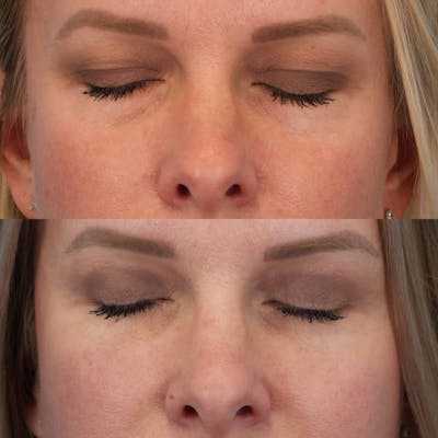 Blepharoplasty Before & After Gallery - Patient 431608 - Image 2