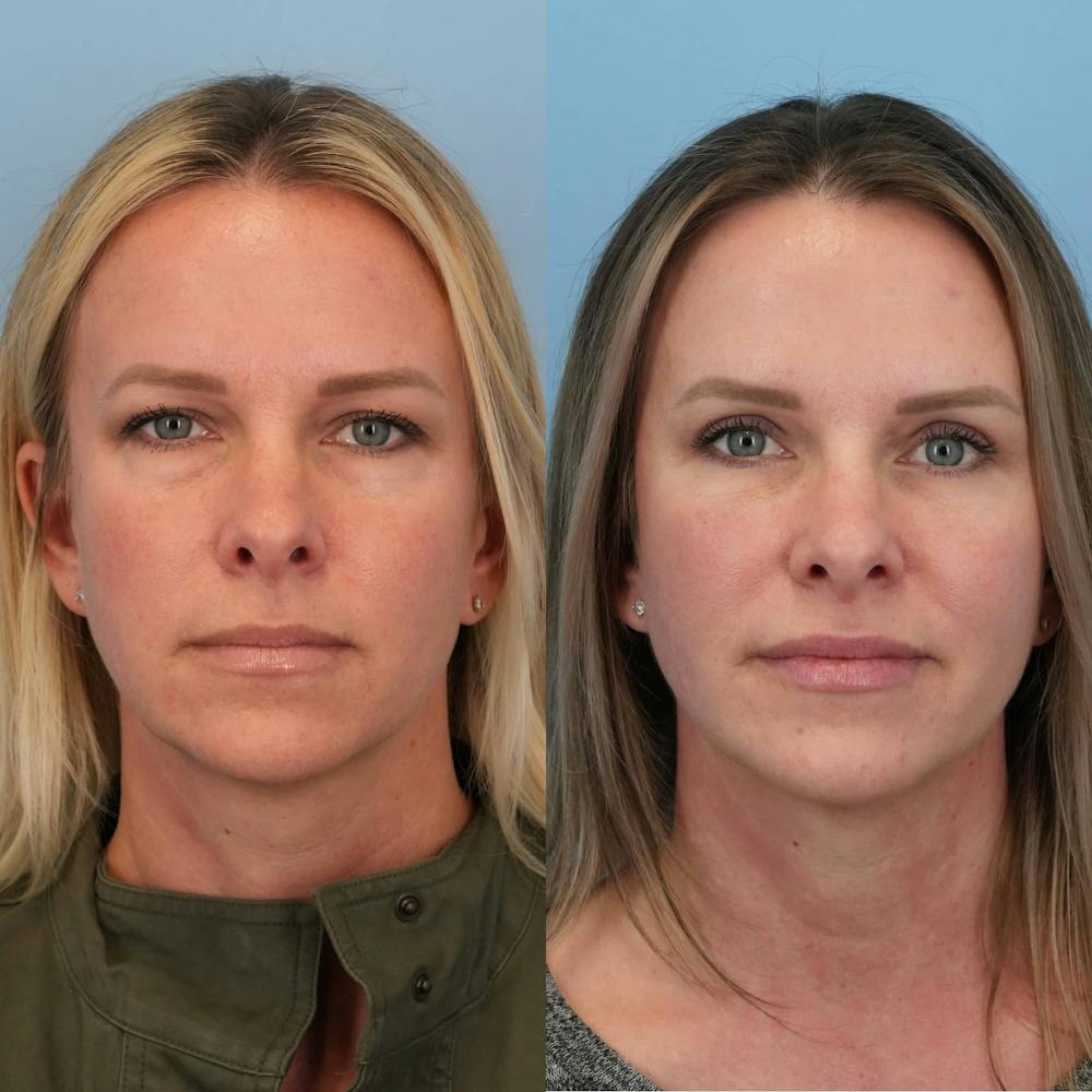Blepharoplasty Before & After Gallery - Patient 431608 - Image 6