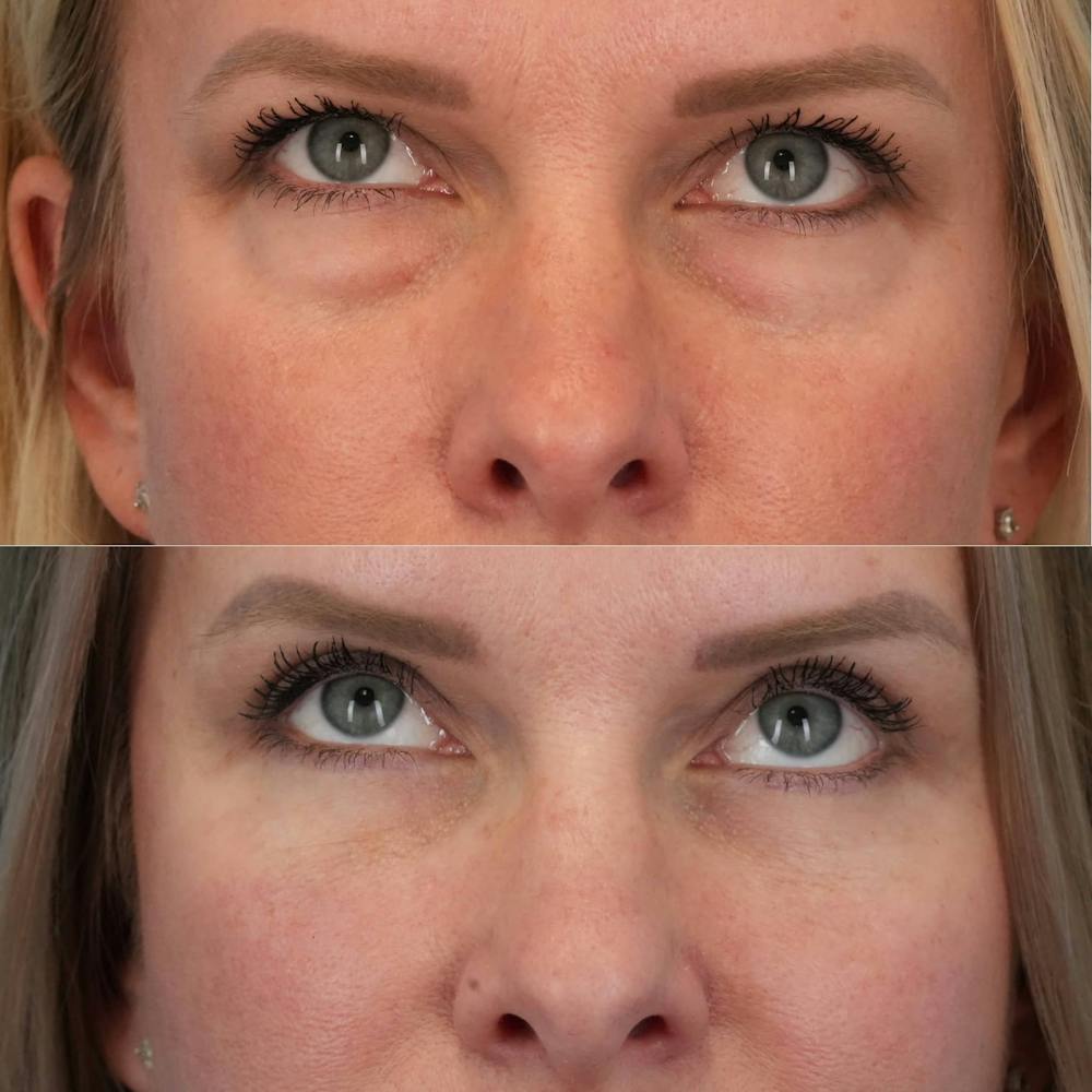 Blepharoplasty Before & After Gallery - Patient 431608 - Image 1