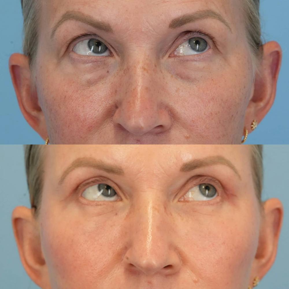 Blepharoplasty Before & After Gallery - Patient 399708 - Image 2