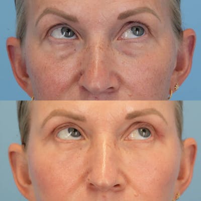 Blepharoplasty Before & After Gallery - Patient 399708 - Image 2