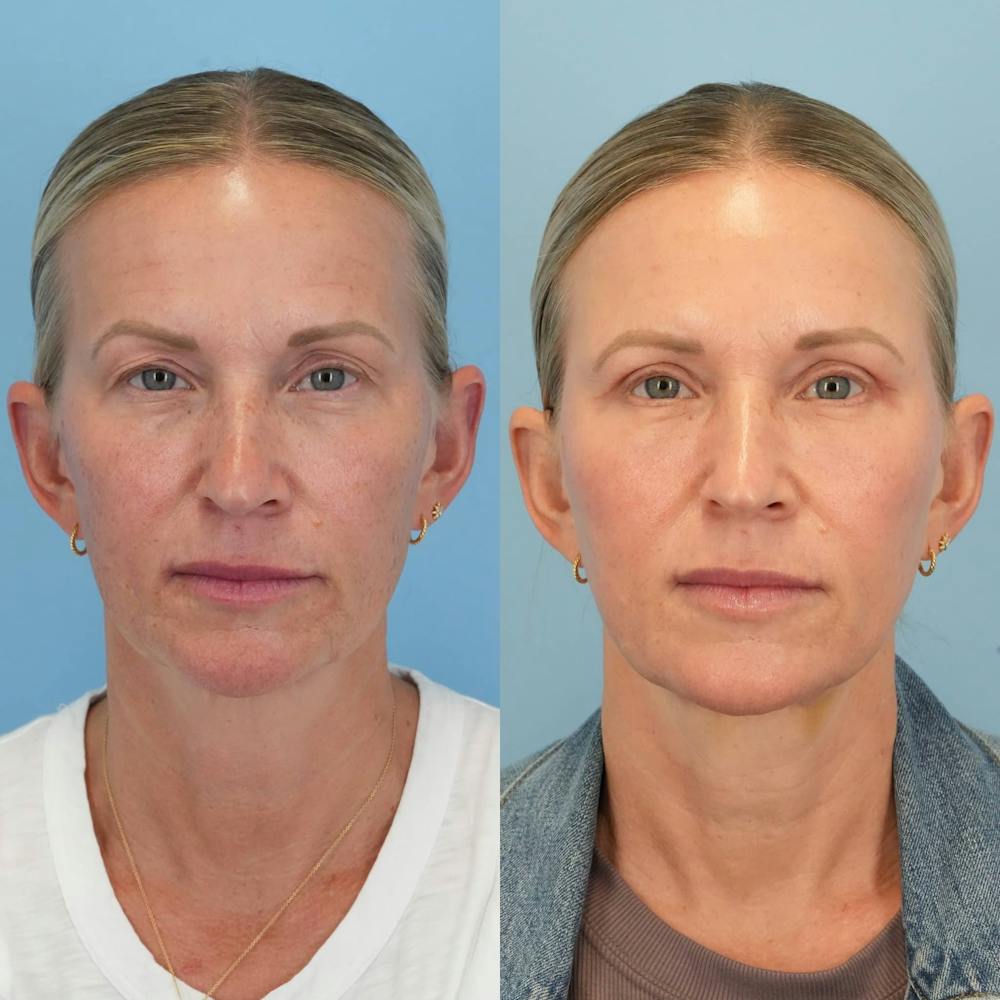 Blepharoplasty Before & After Gallery - Patient 399708 - Image 5