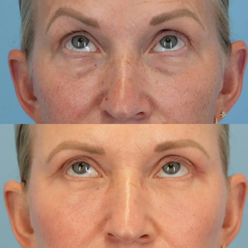 Blepharoplasty Before & After Gallery - Patient 399708 - Image 3