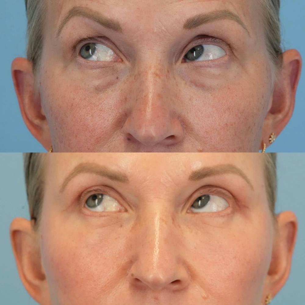 Blepharoplasty Before & After Gallery - Patient 399708 - Image 4