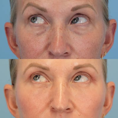 Blepharoplasty Before & After Gallery - Patient 399708 - Image 4