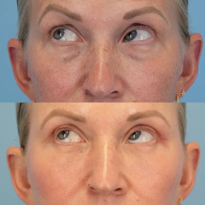 Blepharoplasty Before & After Gallery - Patient 399708 - Image 4