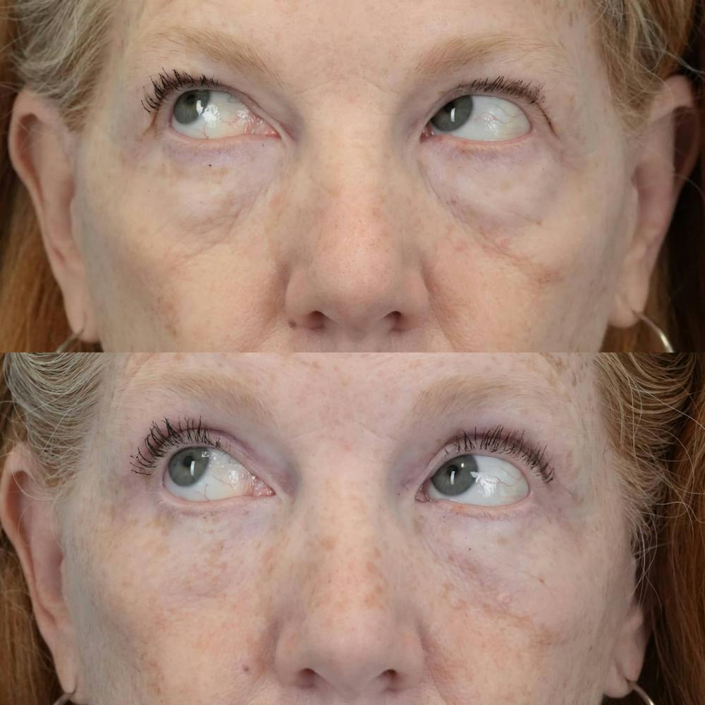 Blepharoplasty Before & After Gallery - Patient 360730 - Image 2