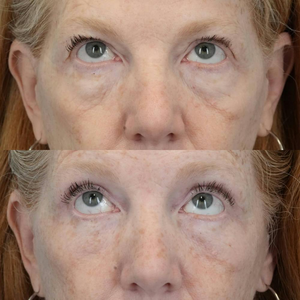 Blepharoplasty Before & After Gallery - Patient 360730 - Image 3