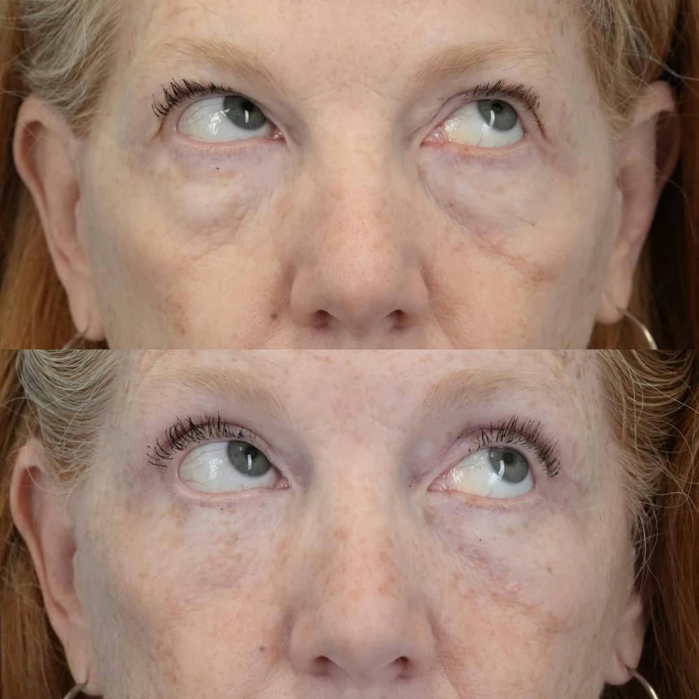 Blepharoplasty Before & After Gallery - Patient 360730 - Image 5
