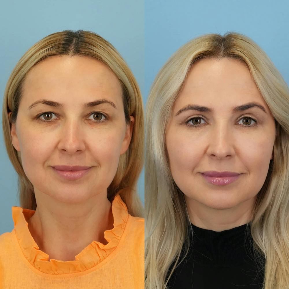 Blepharoplasty Before & After Gallery - Patient 347858 - Image 5