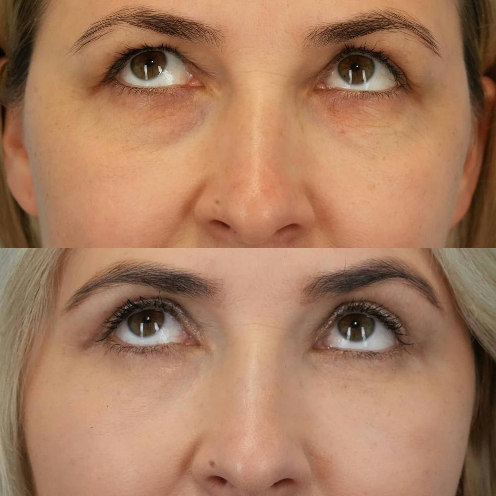 Blepharoplasty Before & After Gallery - Patient 347858 - Image 2
