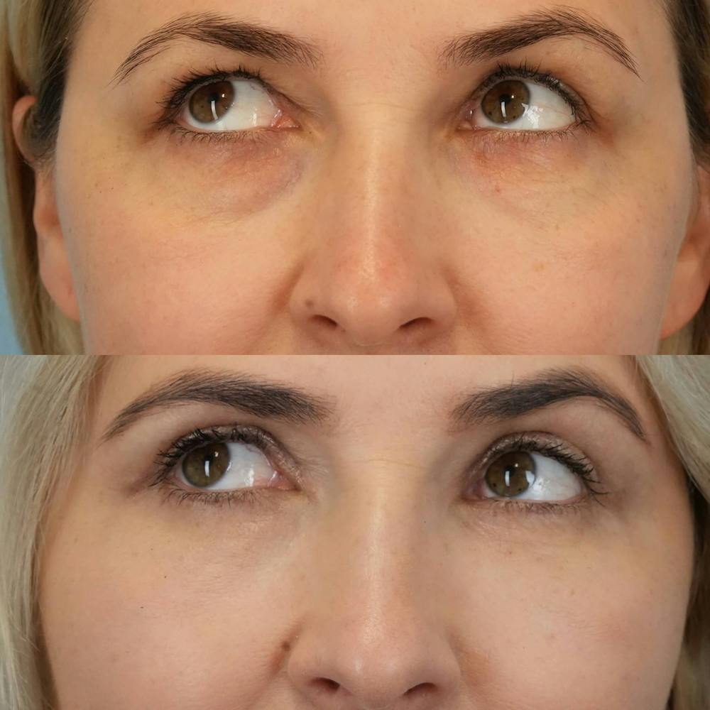 Blepharoplasty Before & After Gallery - Patient 347858 - Image 3