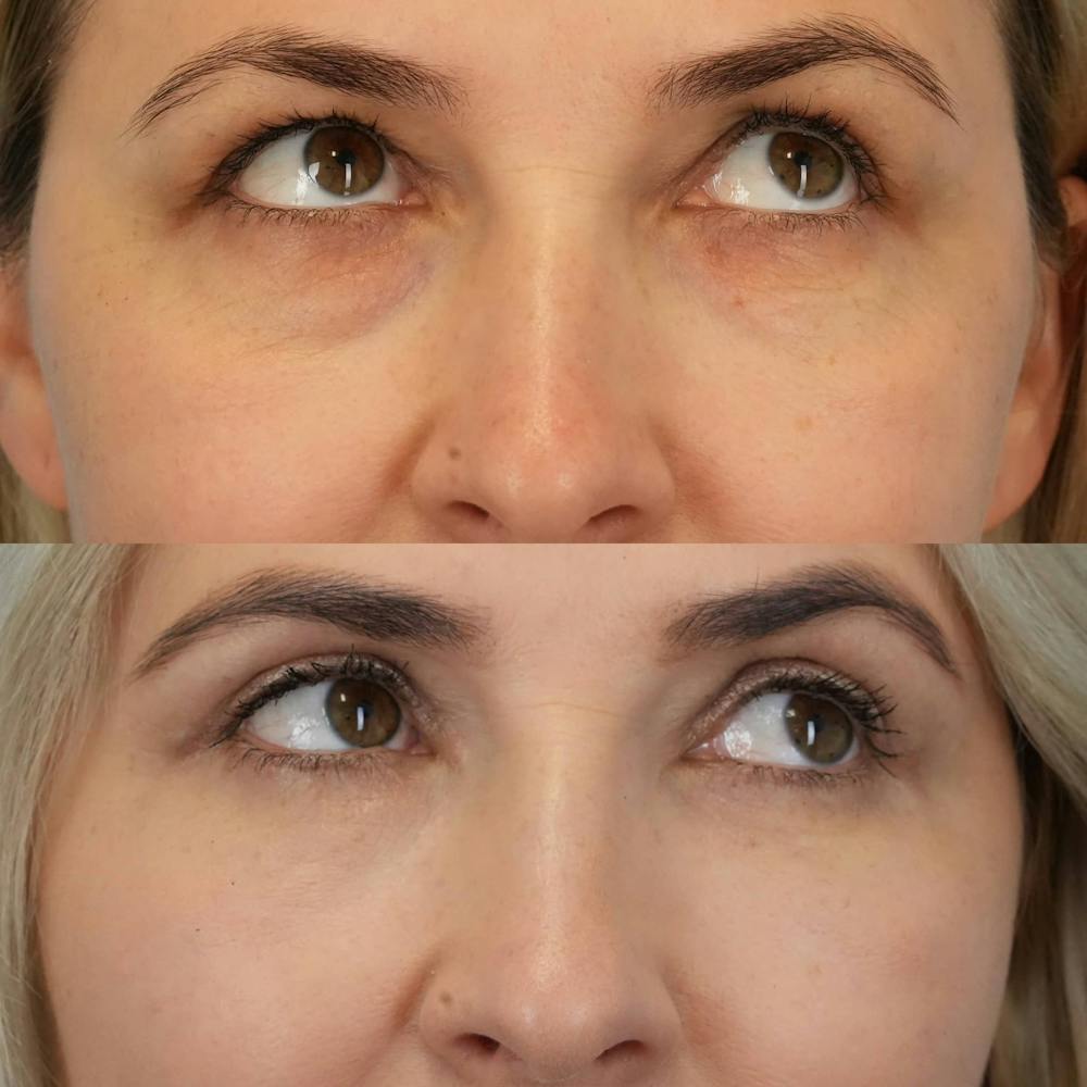Blepharoplasty Before & After Gallery - Patient 347858 - Image 4