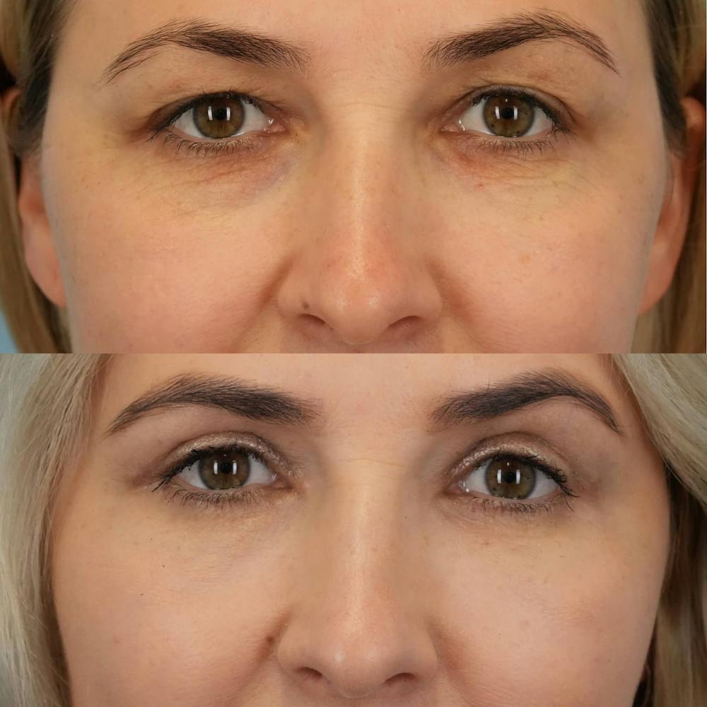 Blepharoplasty Before & After Gallery - Patient 347858 - Image 1