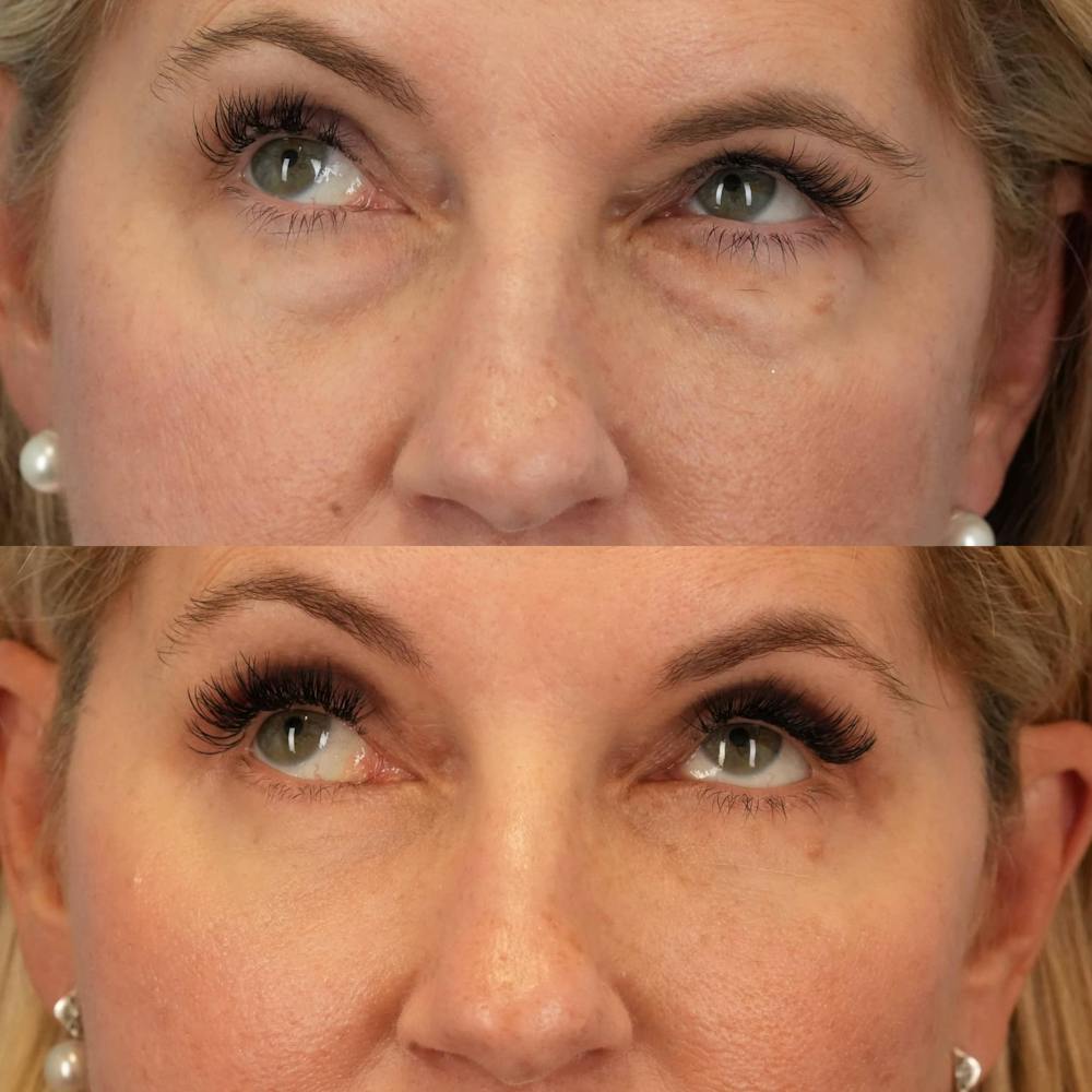 Blepharoplasty Before & After Gallery - Patient 354054 - Image 2