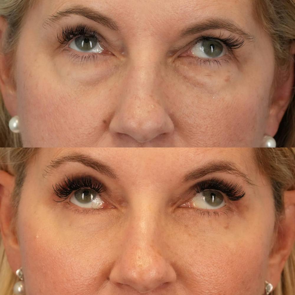 Blepharoplasty Before & After Gallery - Patient 354054 - Image 3