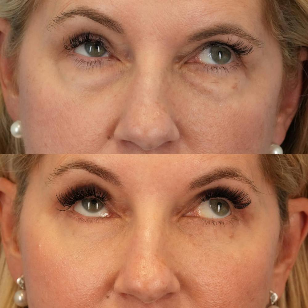 Blepharoplasty Before & After Gallery - Patient 354054 - Image 4