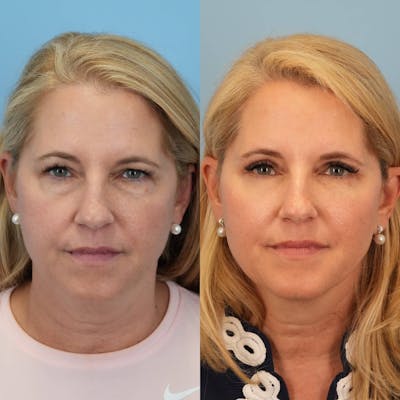 Blepharoplasty Before & After Gallery - Patient 354054 - Image 6