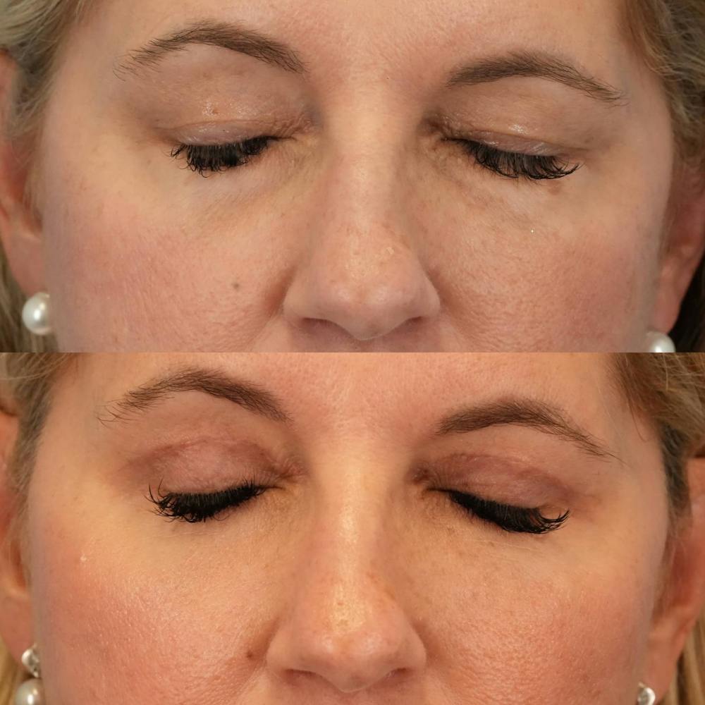 Blepharoplasty Before & After Gallery - Patient 354054 - Image 5