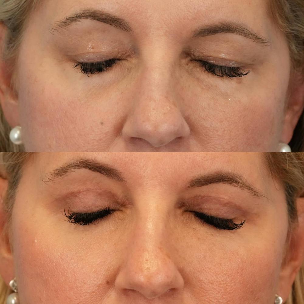 Blepharoplasty Before & After Gallery - Patient 354054 - Image 5