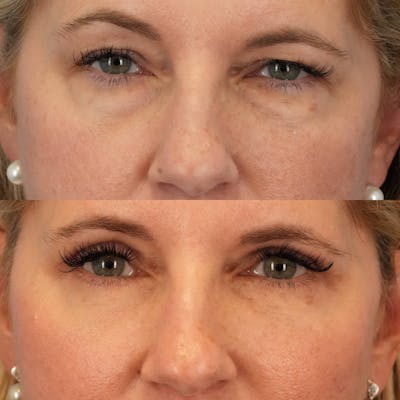 Blepharoplasty Before & After Gallery - Patient 354054 - Image 1