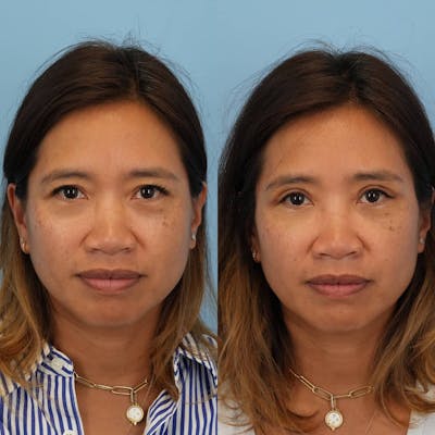 Upper Eyelids Before & After Gallery - Patient 375402 - Image 1