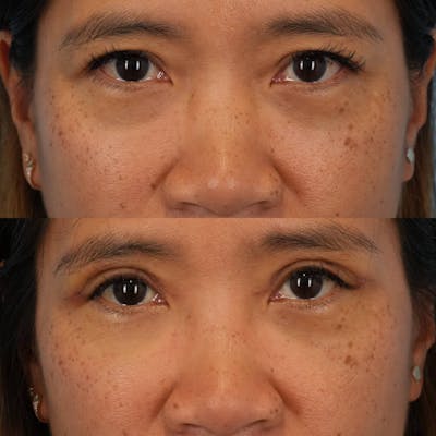 Upper Eyelids Before & After Gallery - Patient 375402 - Image 2