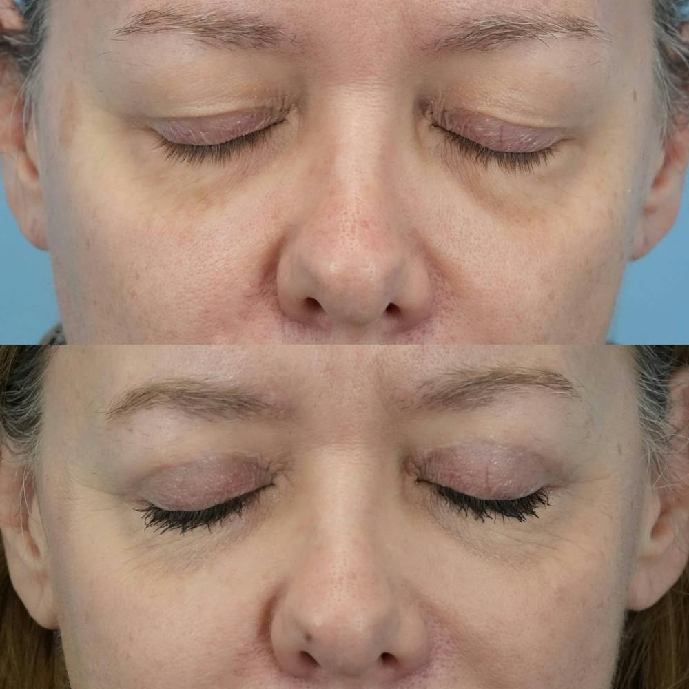 Upper Eyelids Before & After Gallery - Patient 428648 - Image 2