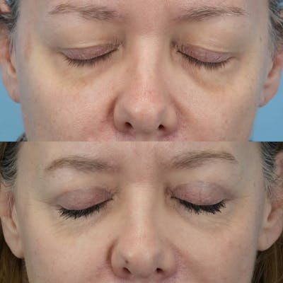 Upper Eyelids Before & After Gallery - Patient 428648 - Image 2