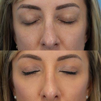 Upper Eyelids Before & After Gallery - Patient 467861 - Image 2
