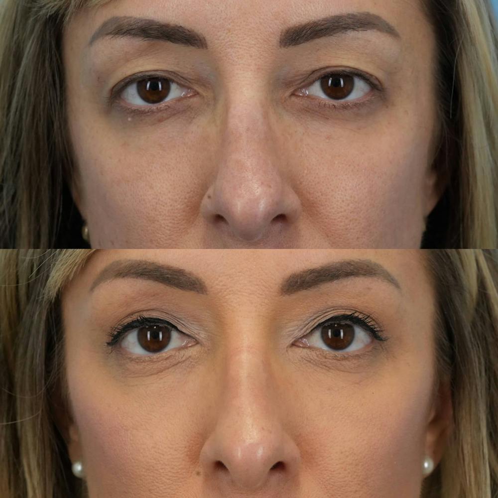 Upper Eyelids Before & After Gallery - Patient 467861 - Image 3