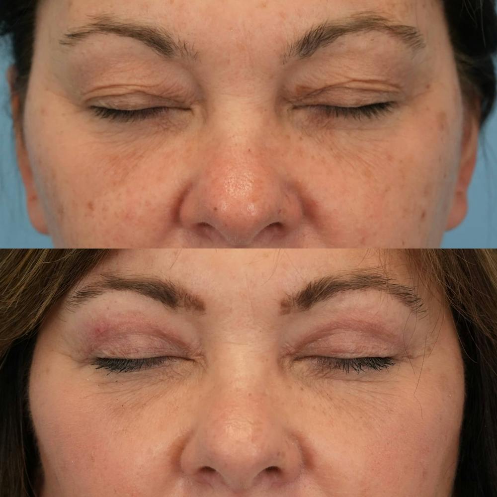 Upper Eyelids Before & After Gallery - Patient 187445 - Image 2
