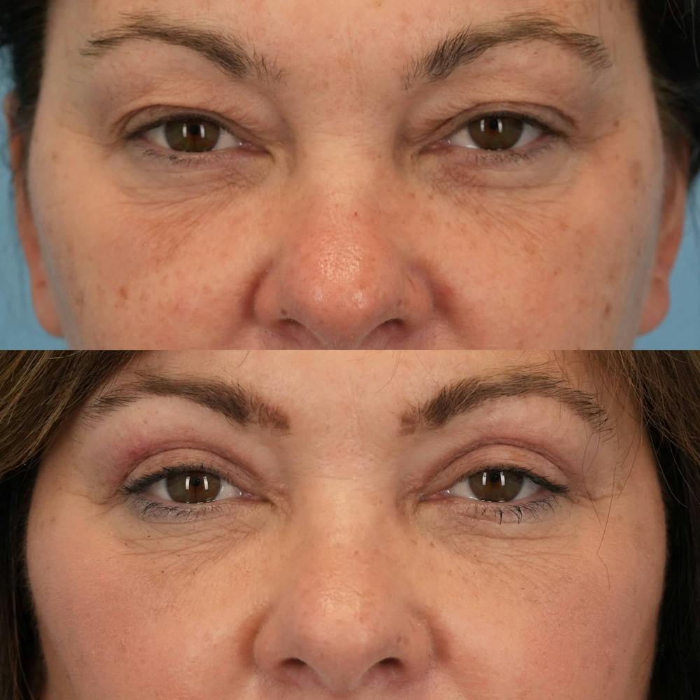 Upper Eyelids Before & After Gallery - Patient 187445 - Image 3
