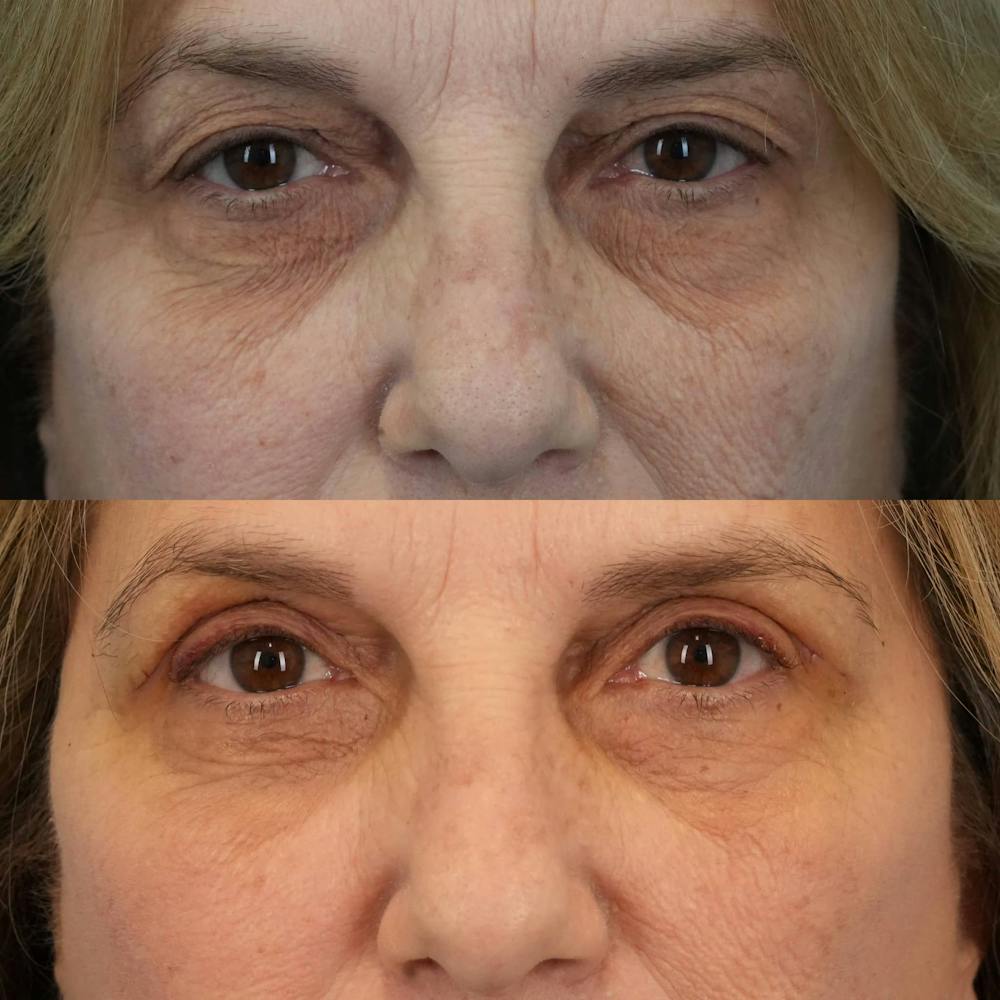 Upper Eyelids Before & After Gallery - Patient 400007 - Image 2