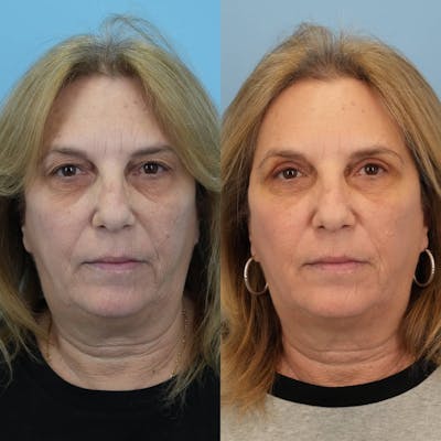 Upper Eyelids Before & After Gallery - Patient 400007 - Image 1