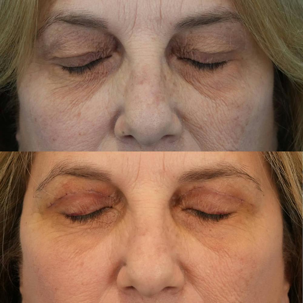 Upper Eyelids Before & After Gallery - Patient 400007 - Image 3