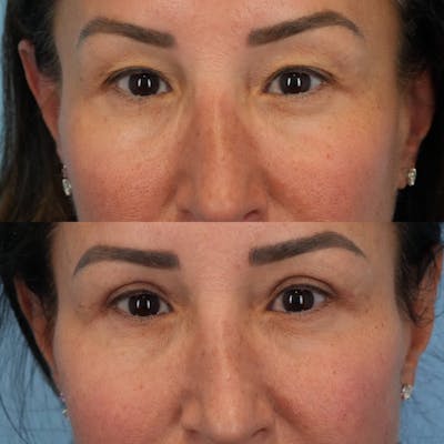 Upper Eyelids Before & After Gallery - Patient 265230 - Image 2