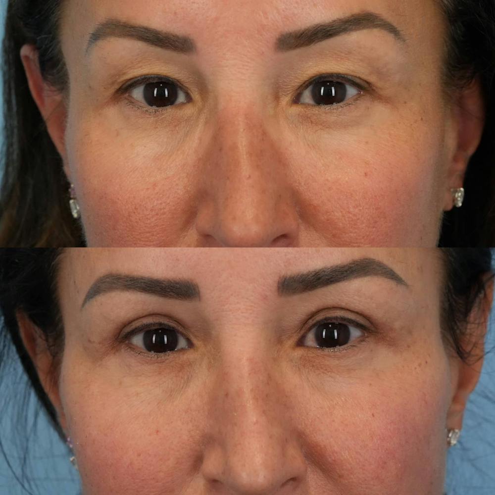 Upper Eyelids Before & After Gallery - Patient 265230 - Image 2