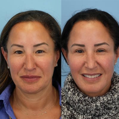 Upper Eyelids Before & After Gallery - Patient 265230 - Image 1