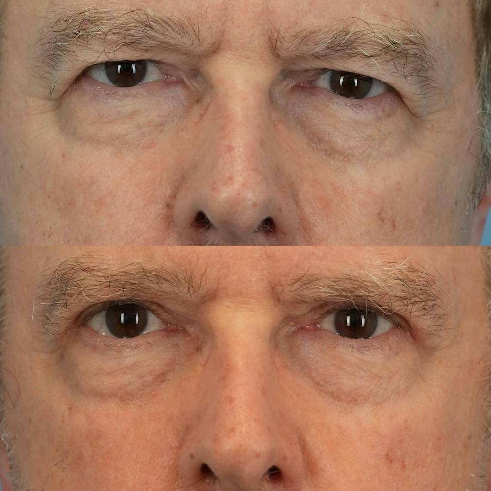 Upper Eyelids Before & After Gallery - Patient 924224 - Image 1