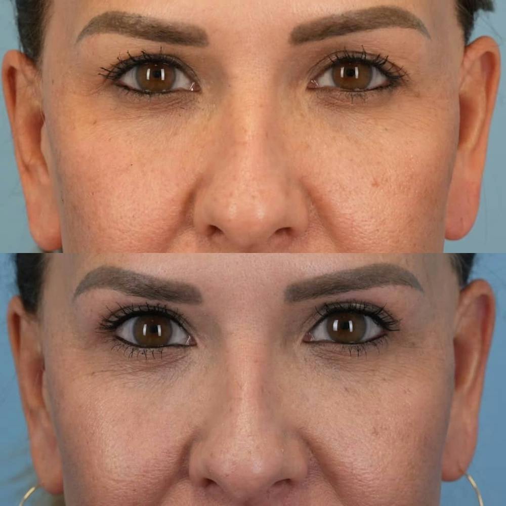 Upper Eyelids Before & After Gallery - Patient 864979 - Image 2