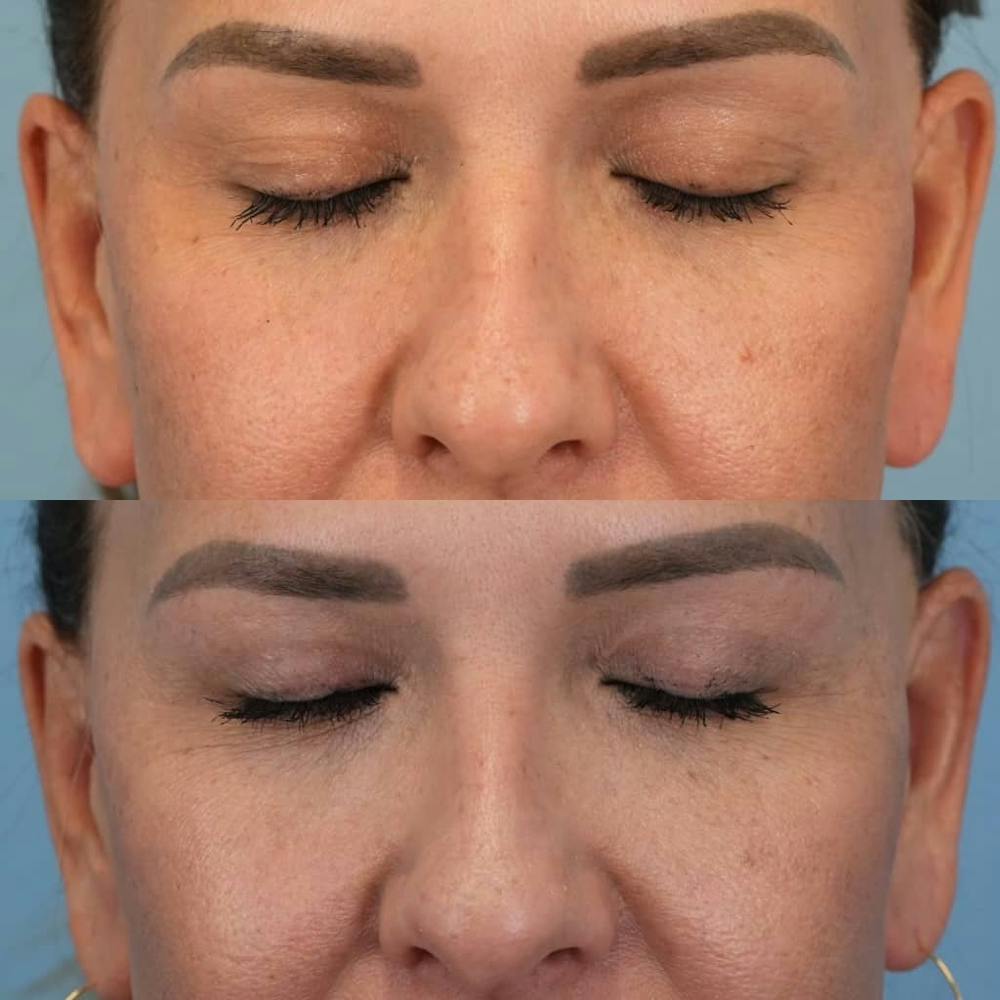 Upper Eyelids Before & After Gallery - Patient 864979 - Image 3