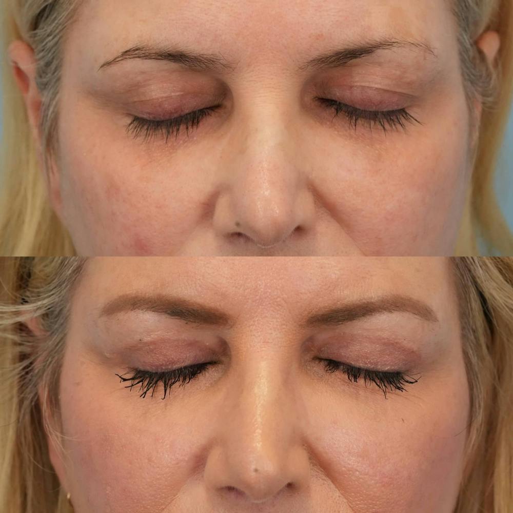 Upper Eyelids Before & After Gallery - Patient 374797 - Image 2