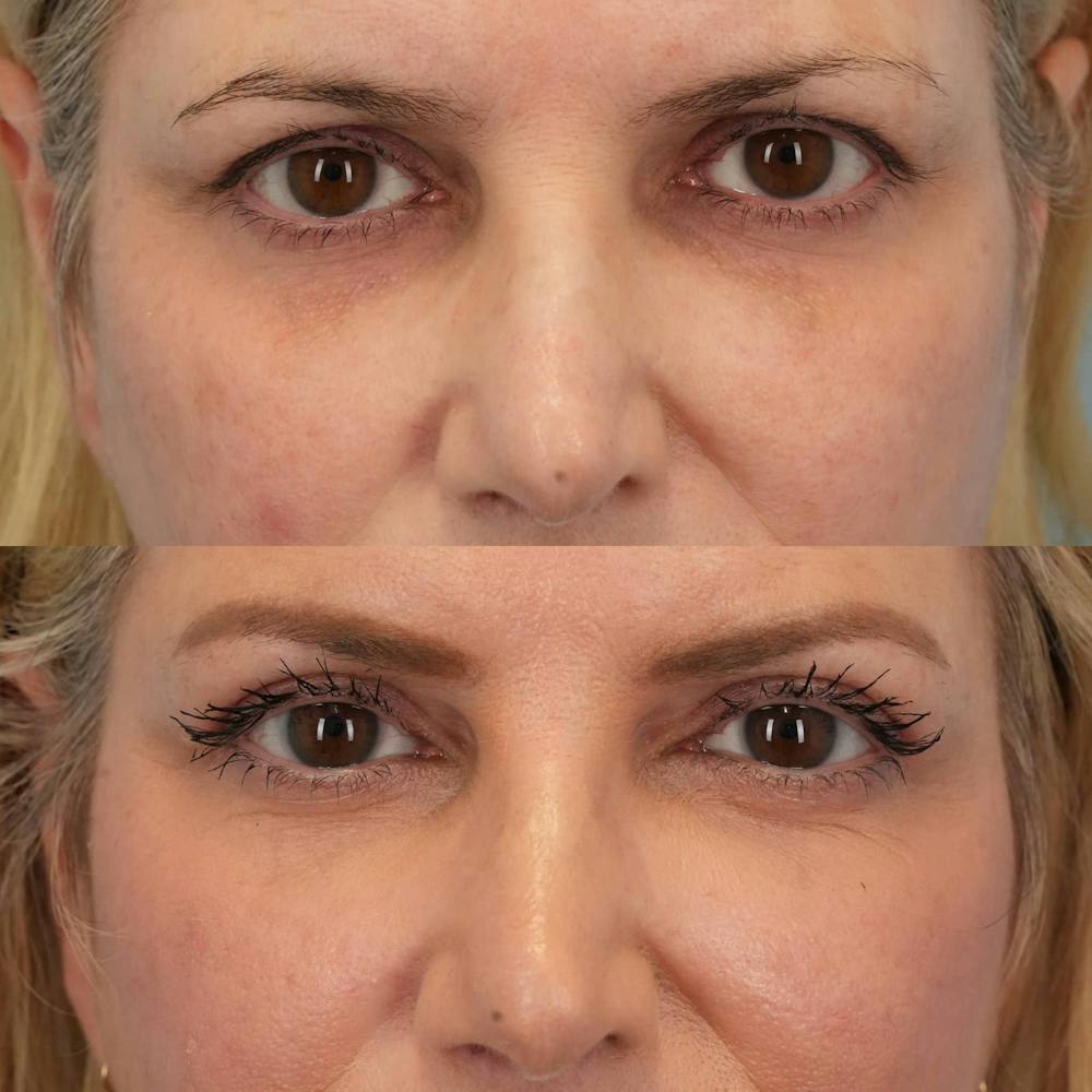 Upper Eyelids Before & After Gallery - Patient 374797 - Image 1