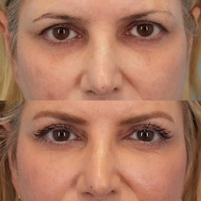 Upper Eyelids Before & After Gallery - Patient 374797 - Image 1