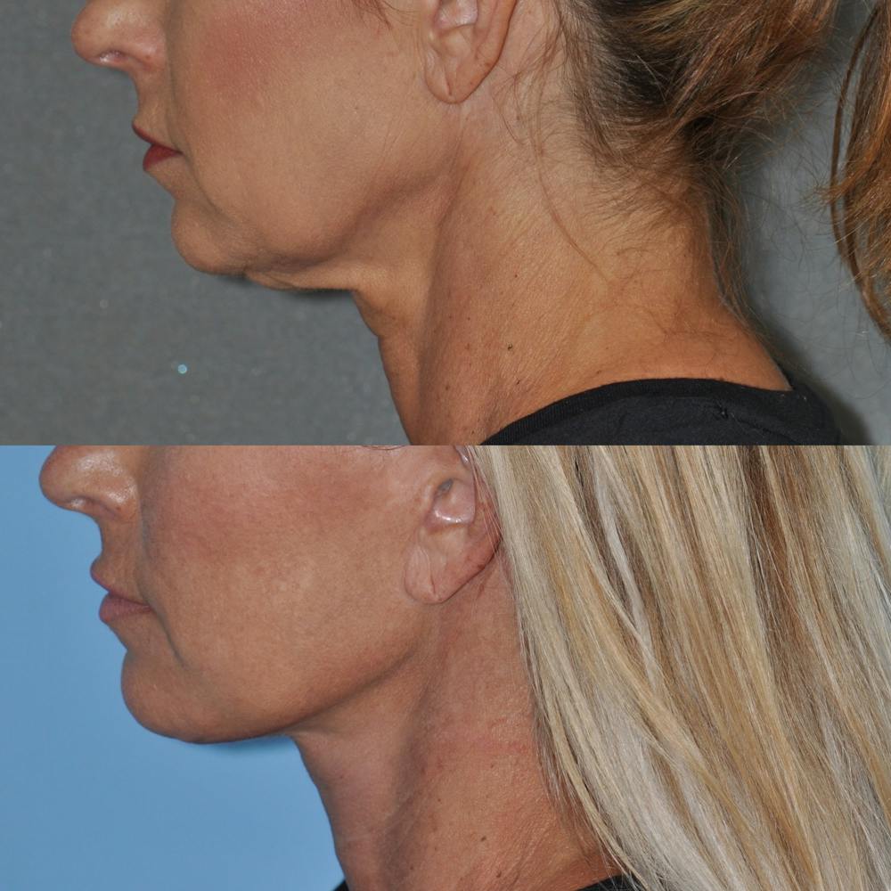 Facelift Before & After Gallery - Patient 127520 - Image 5